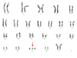 Chromosomes from a Down syndrome affected fetus