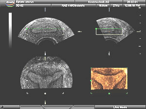 3D image of a bicornuate uterus