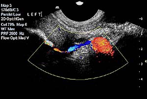 Colour doppler imaging of the fallopian tube during HyCoSy