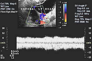 Image of colour doppler of a complex cyst