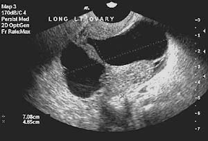 Image of a complex ovarian cyst