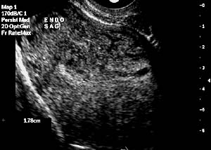 Sonohysterography - Before saline infusion