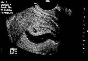 Sonohysterography - After saline infusion