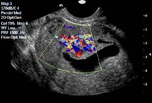 Colour doppler imaging of the endometrial polyp during Sonohysterography