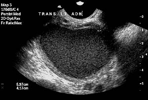 Image of endometrioma