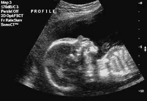 Fetal face at 18 Weeks