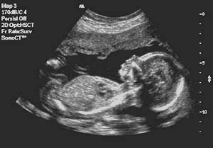 Fetal profile at 18 weeks