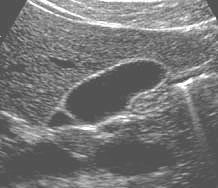 Image of a normal gall bladder