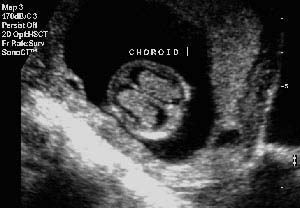 A cross section through the fetal head at 12 weeks