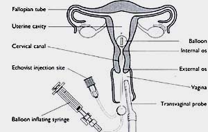 Diagram of the HyCoSy procedure