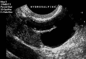 Hydrosalpinx