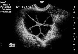 Ovary stimulated during an IVF cycle