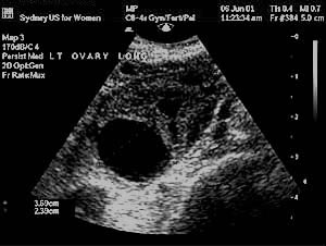 Image of ovary with follicle