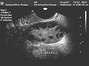 Image of polycystic ovarian sydrome