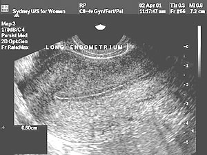 Transvaginal image of uterus with proliferative endometrium