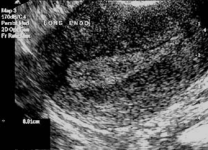 Transvaginal image of uterus with secretory endometrium