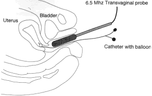 Diagram of Sonohysterography