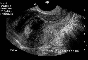 Image of fibroid distorting the endometrium