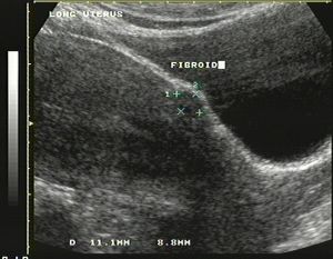 Image of fibroid uterus