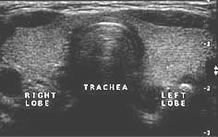 Image of a normal thyroid gland