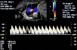 Regular Fetal heartbeat