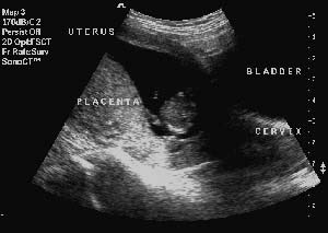 Uterus with an enclosed Gestation Sac